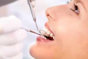 Read more about the article Are Composite Fillings Better?