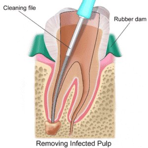 Read more about the article Dr. David Brusky on What to Expect During a Root Canal