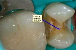 Cracked Tooth