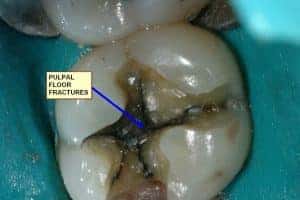 Vertical Root Fracture