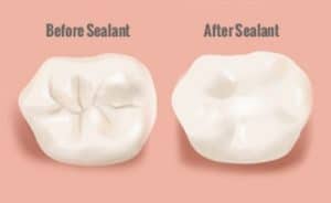 Read more about the article What’s the Difference Between Dental Fillings, PRR & Sealants?