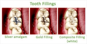 dental fillings Green Bay