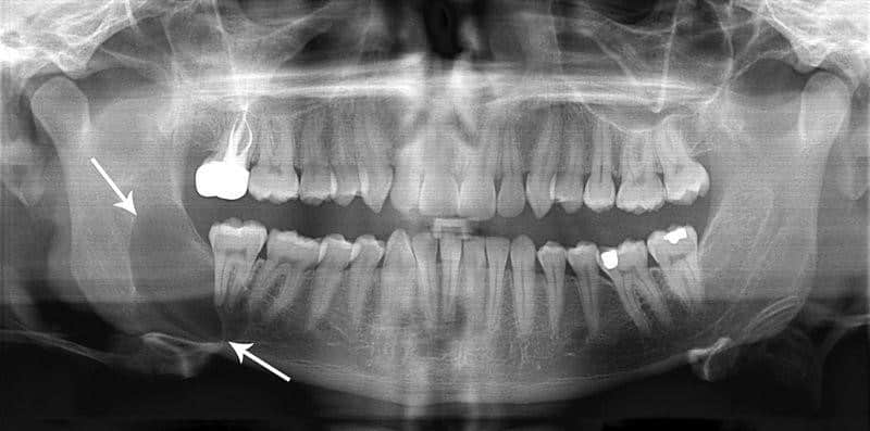 Keratocyst Which Leads to Weak Jaws