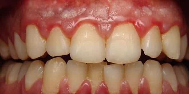 You are currently viewing What You Should Know about Gingivitis
