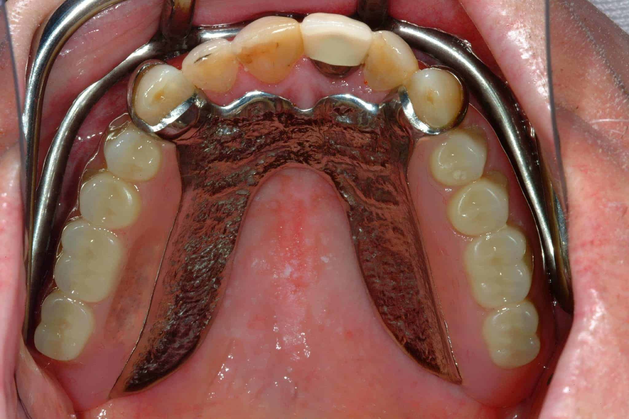 Bridges and Crowns After