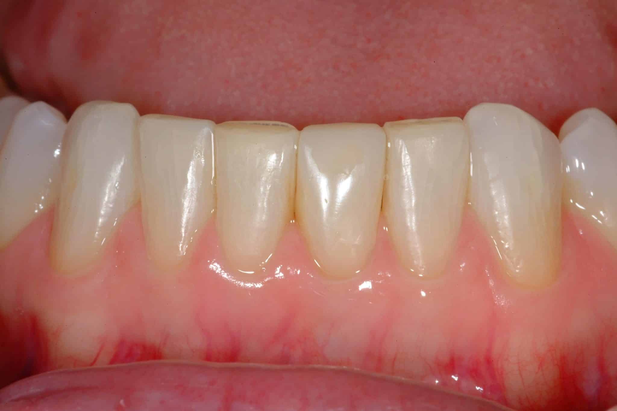 Bridges and Crowns After