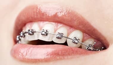 Orthodontics and Implants