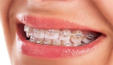Orthodontics and Tooth-colored Fillings