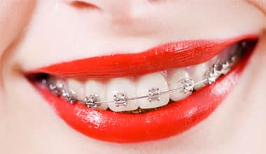 Orthodontics and Crowns/Veneers/Bridges