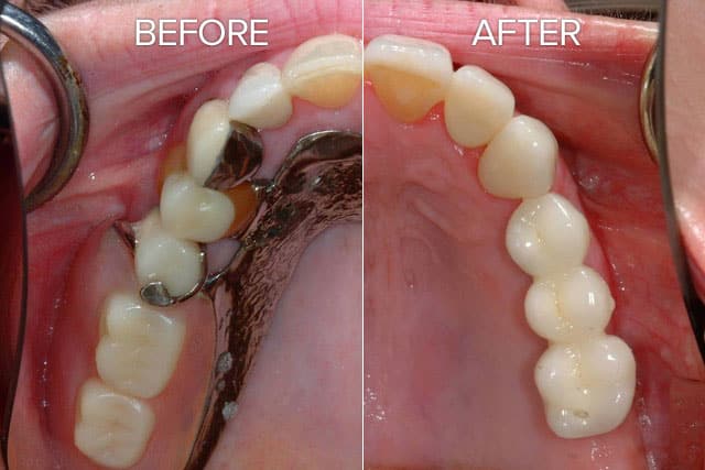 Read more about the article Implant bridges are the closest thing to having your own teeth