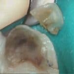 Tooth with cavity