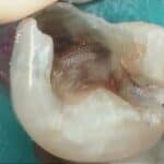 Tooth with cavity